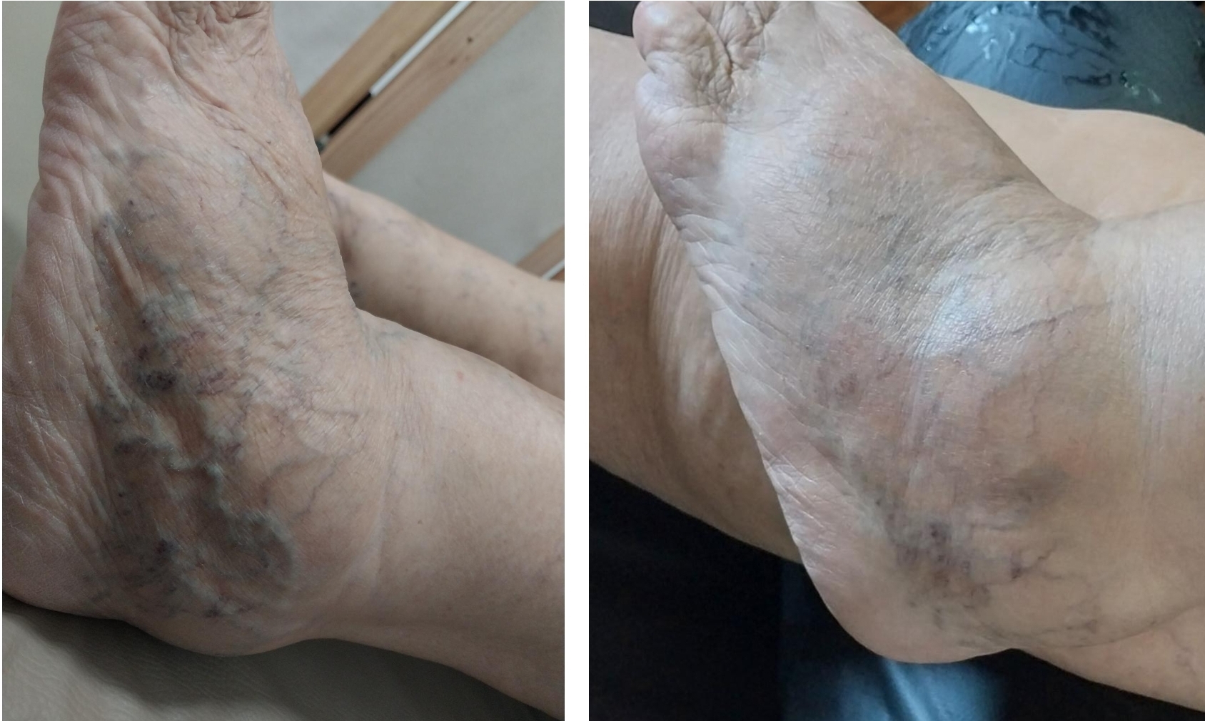 Antes e depois — ferida crônica