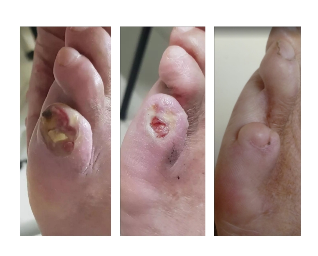 Cicatrização com ozônioterapia